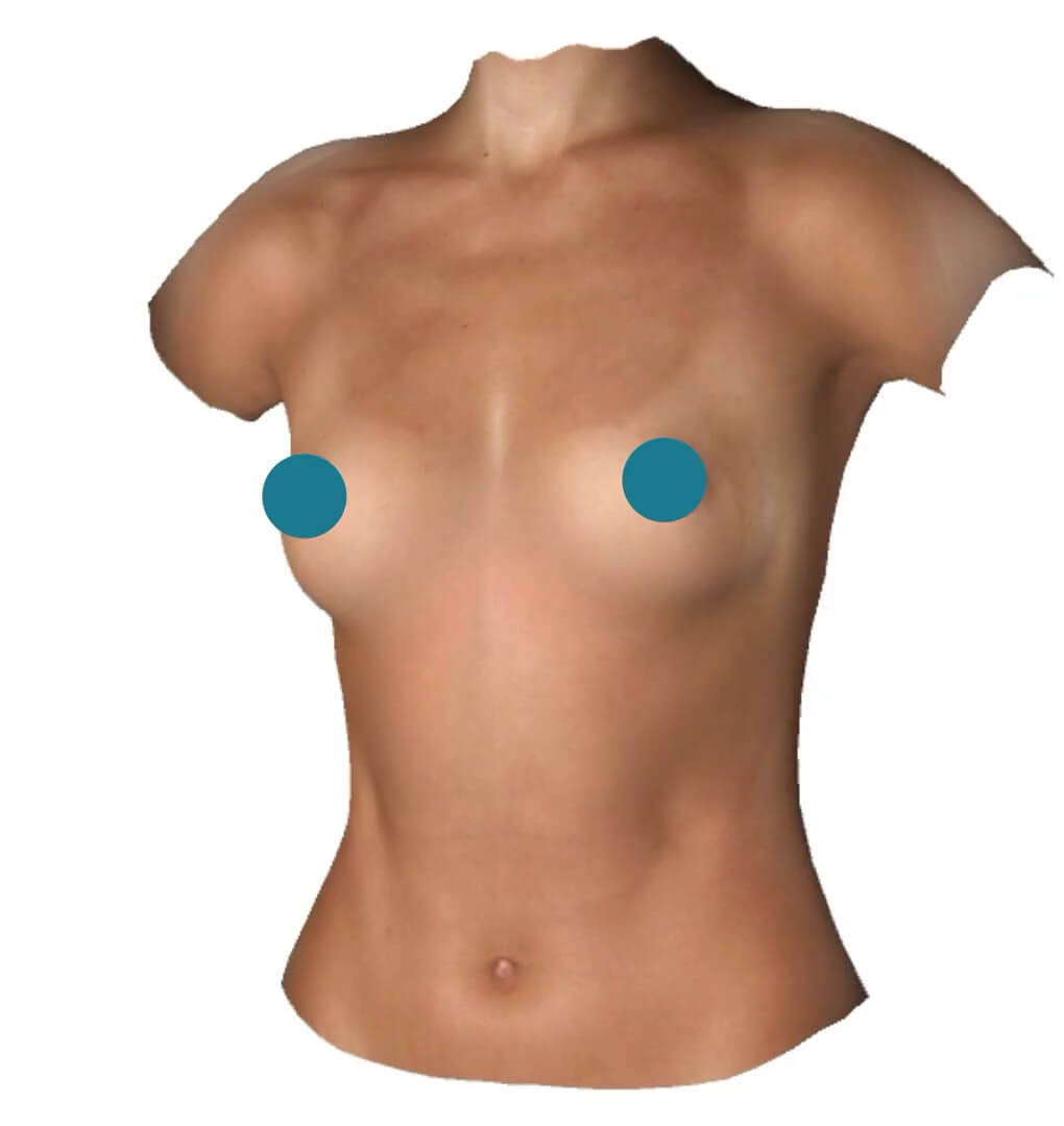 Breast Augmentation Visualization Tool, Blog