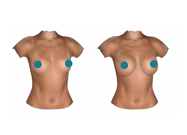 Breast Augmentation Newport Coast CA – Breast Augmentation Newport Beach CA