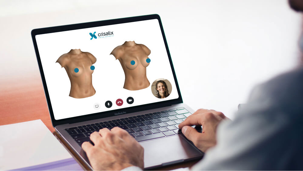 Tummy tuck with Crisalix 3D simulation, Clinimedspa